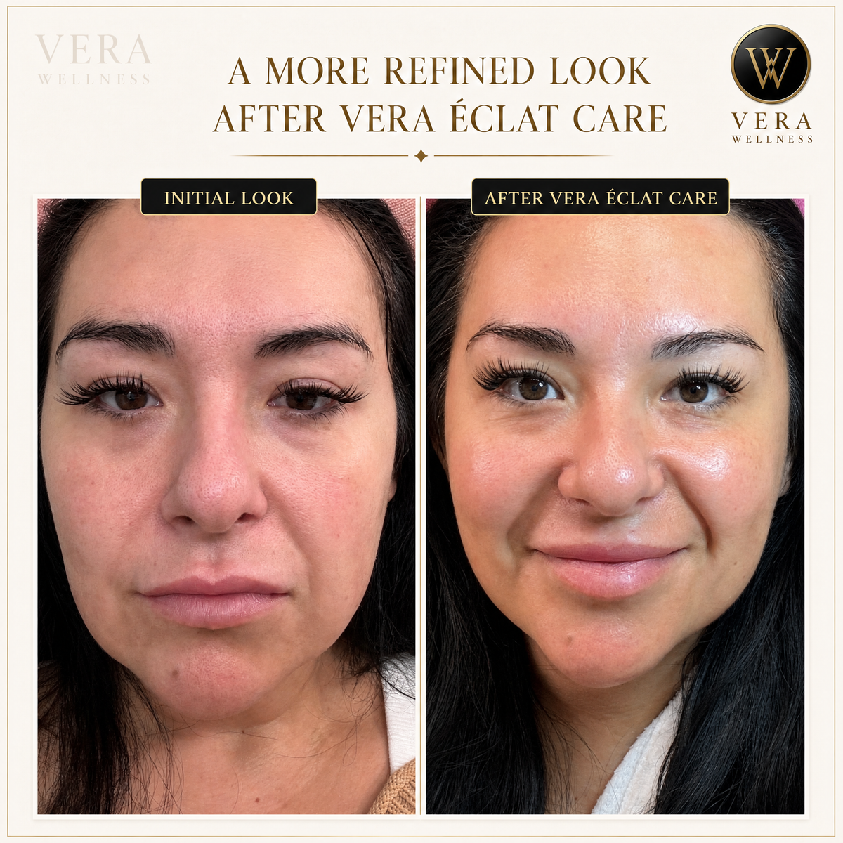 VERA ÉCLAT™  Medical-Grade 3-in-1 RF, Microcurrent & Tri-Wavelength LED Facial System  Clinical-grade technology. One refined device. Visible, consistent results at home — no appointments, no downtime, no guesswork.