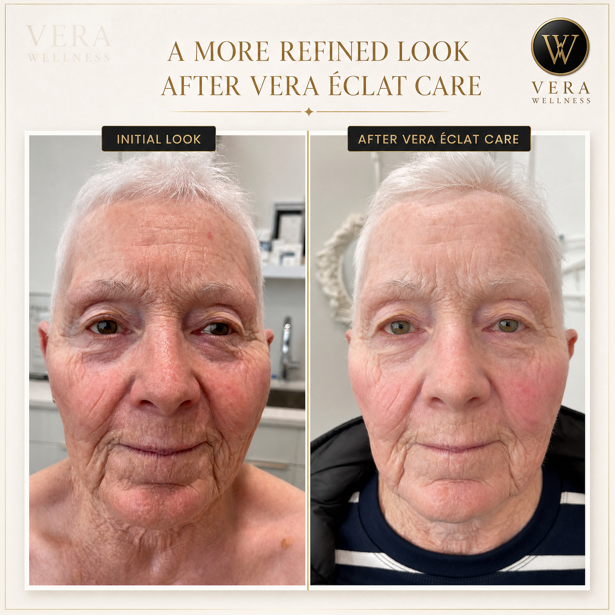 VERA ÉCLAT™  Medical-Grade 3-in-1 RF, Microcurrent & Tri-Wavelength LED Facial System  Clinical-grade technology. One refined device. Visible, consistent results at home — no appointments, no downtime, no guesswork.